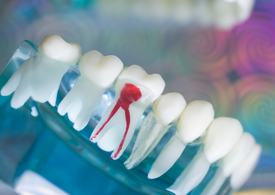 根管治療（歯内療法）